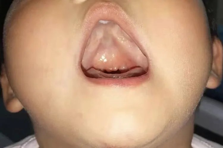 唇腭裂和兔唇的区别图片