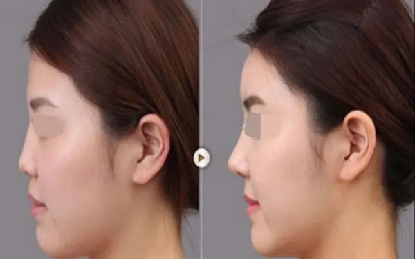 隆鼻大概多少钱