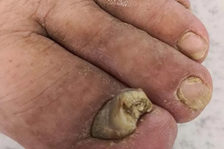 灰指甲图片怎么治疗