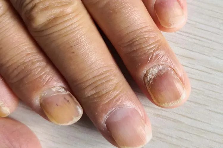 灰指甲图片怎么治疗