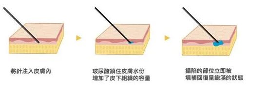 打玻尿酸一针要多少钱