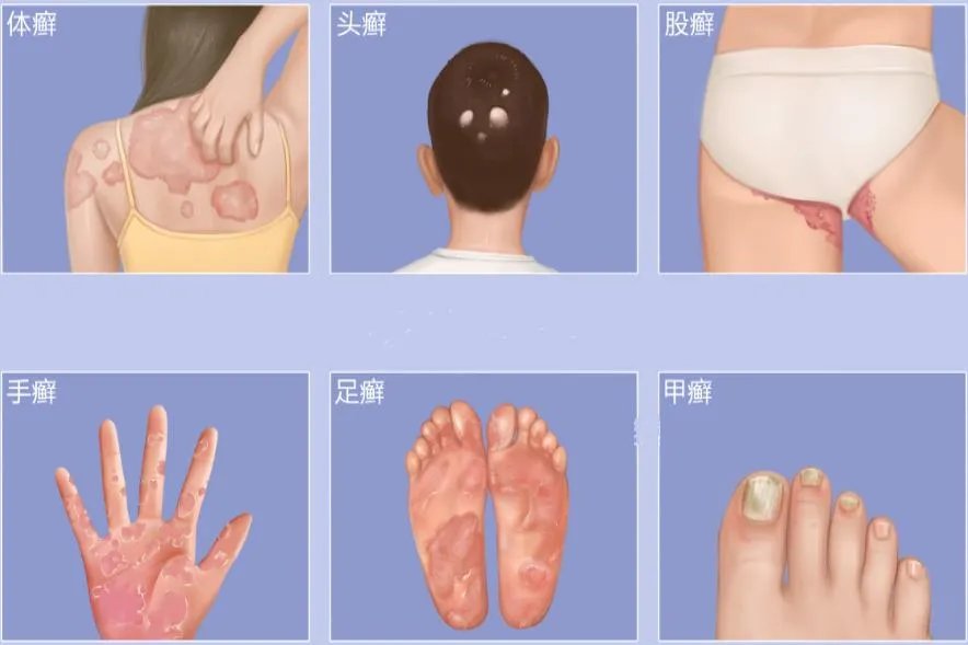 癣的种类图片