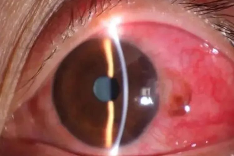 沙尘暴可以诱发什么部位的疾病