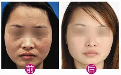 激光祛斑一次多少钱