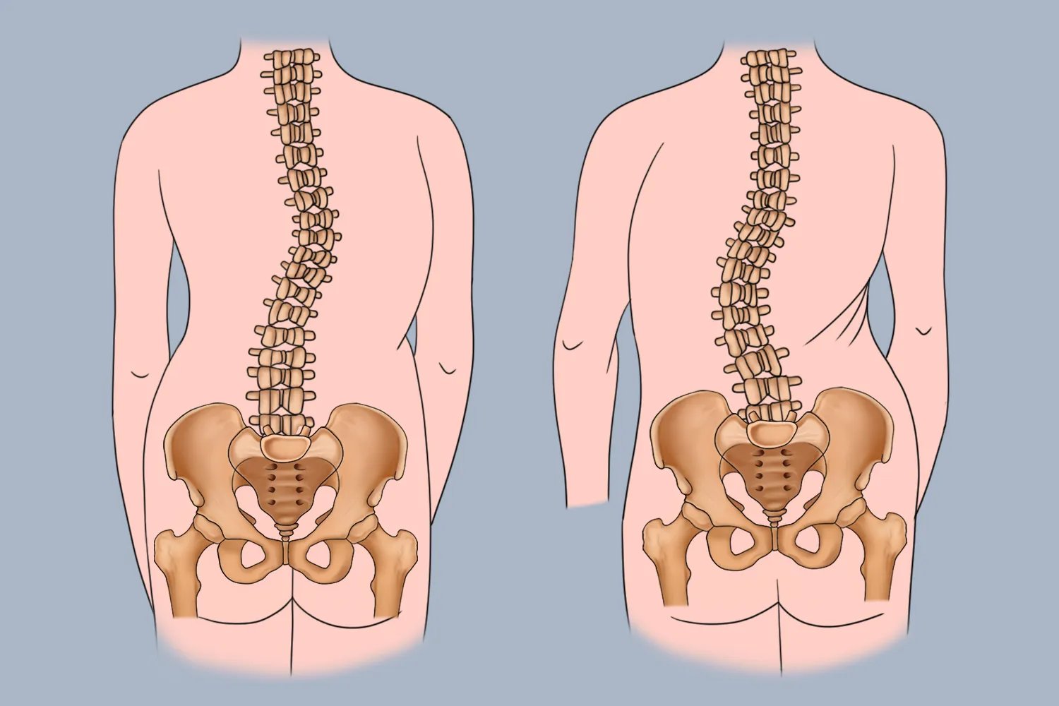 左右胯骨不对称图片