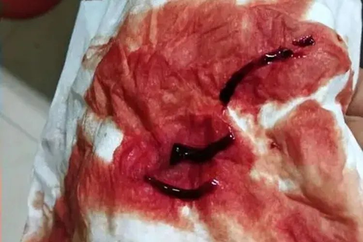 月经时流出红色线虫图片