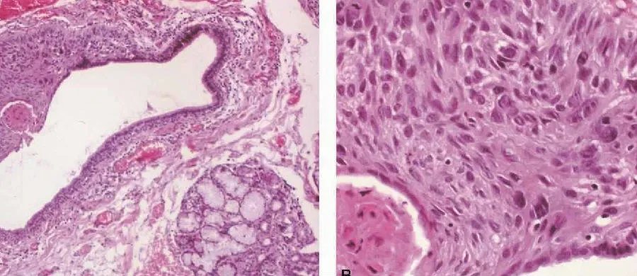 【图】鳞状细胞癌详细图解（唾液腺恶性肿瘤的临床病理）