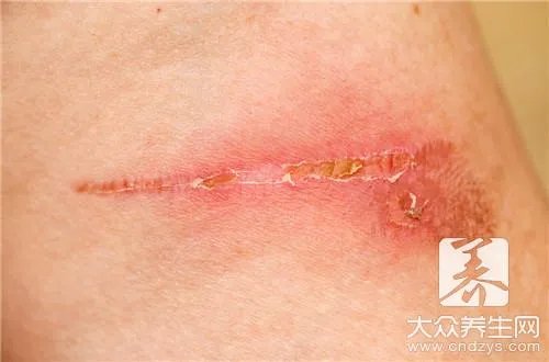 瘢痕增生的治疗方法是什么