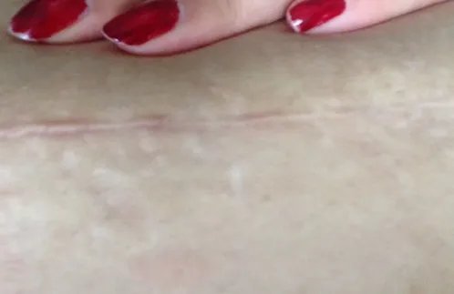 怎样有效去除手术疤痕
