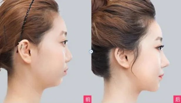 玻尿酸隆鼻多少钱一针