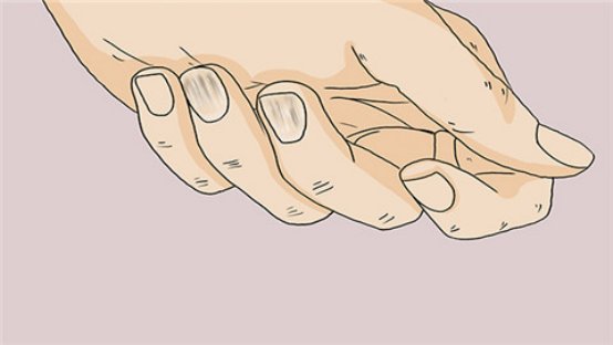 指甲竖纹多是癌症吗