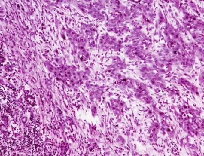 【图】鳞状细胞癌详细图解(唾液腺恶性肿瘤的临床病理)