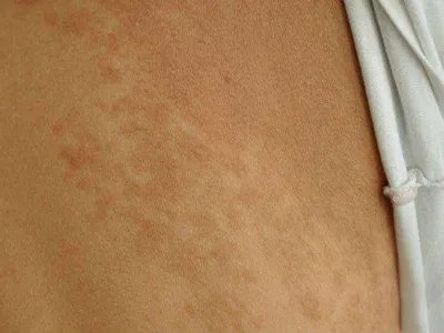 进行性色素性紫癜性皮肤病症状图片