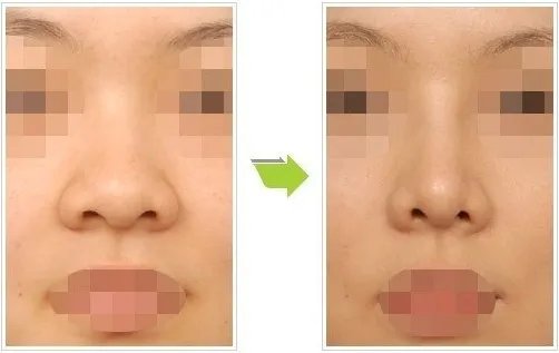 鼻翼缩小要多少钱啊