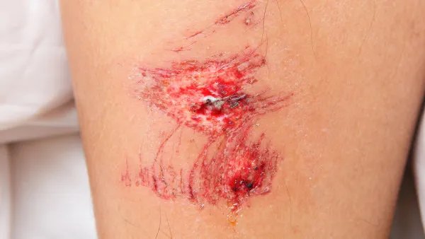 伤口发炎怎么处理