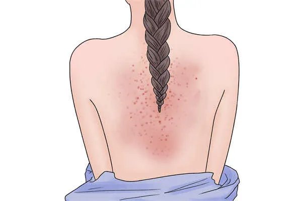 皮肤过敏吃什么药好