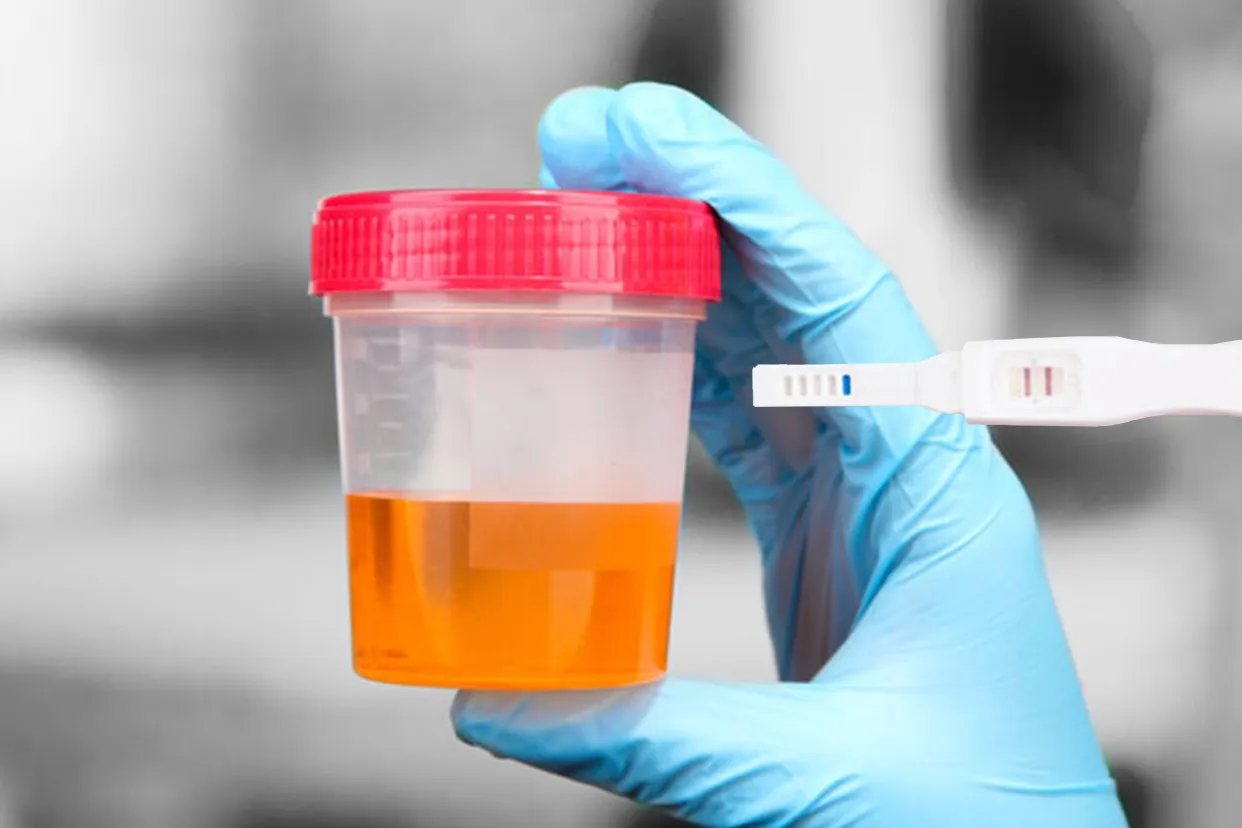 尿酮体阳性严重吗