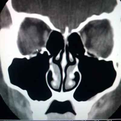 尘螨过敏性鼻炎是怎么回事?