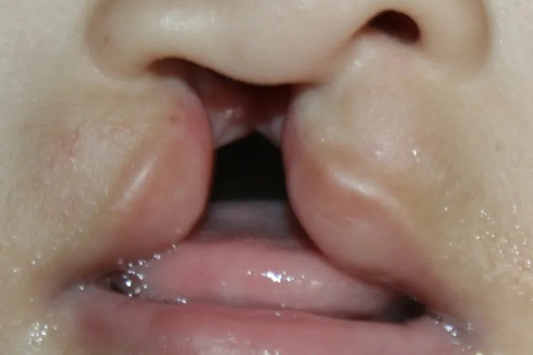 唇腭裂和兔唇的区别图片