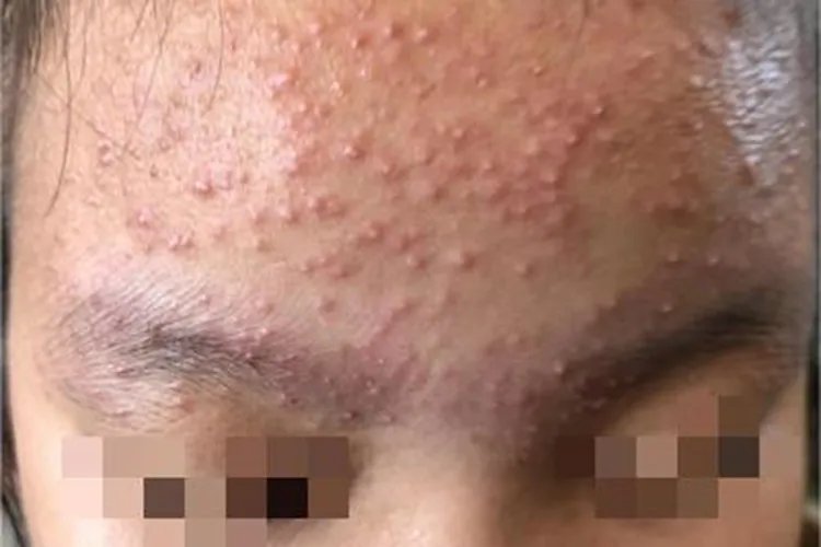 螨虫皮炎症状图片