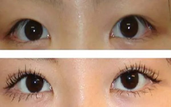 韩式双眼皮手术价格