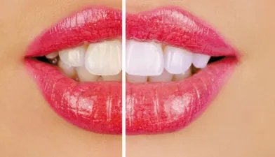 超声波洗牙多少钱