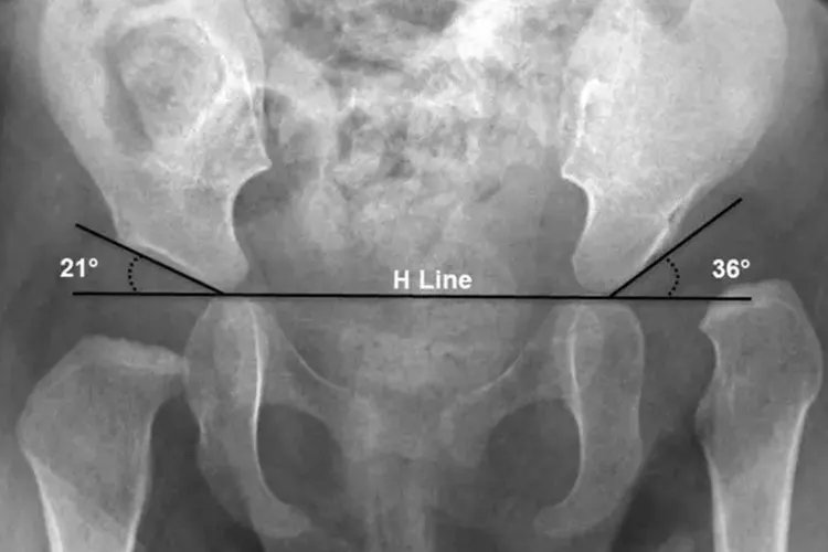 左右胯骨不对称图片