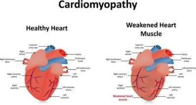 扩张型心肌病心衰三度怎么办