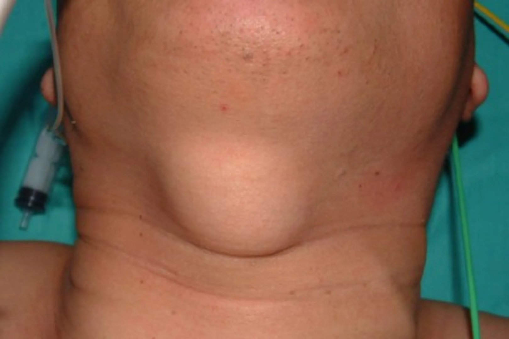 脖子咽喉处有肿块图片