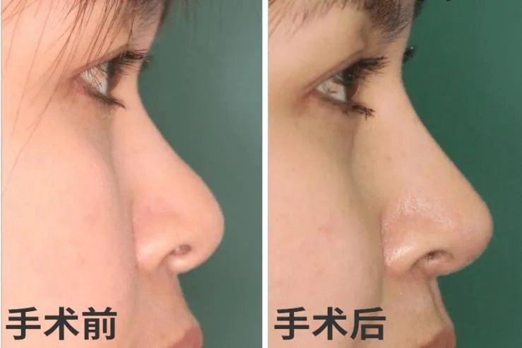 鼻子打玻尿酸效果图