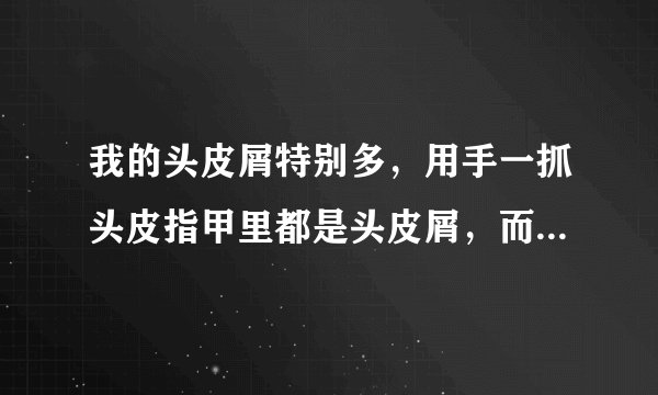 我的头皮屑特别多，用手一抓头皮指甲里都是头皮屑，而...