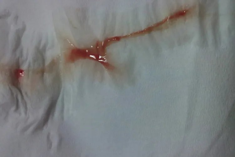 月经与出血的区别图片