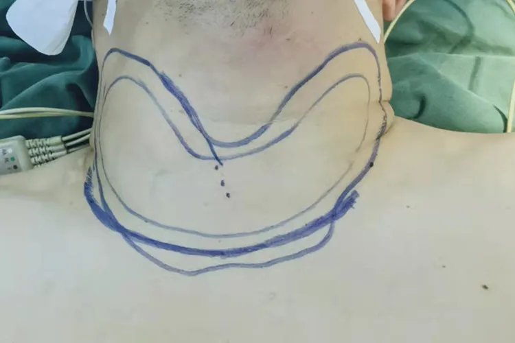 甲状腺肿大图片