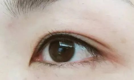 美瞳线手术有哪些后遗症？