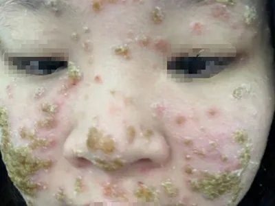 卡波西水痘样疹黄痂图片