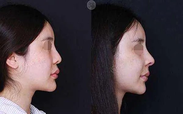 北京硅胶隆鼻哪家医院好