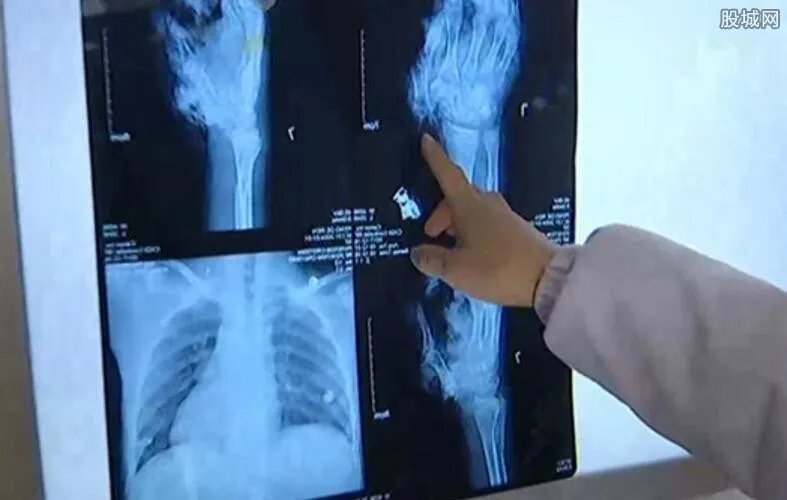 三无mp3突然爆炸 18元买来MP3结果悲剧了