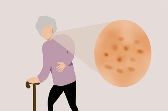 如何消除脸上老年斑