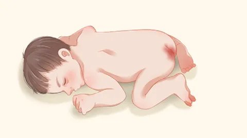 热痱子怎么治好得快