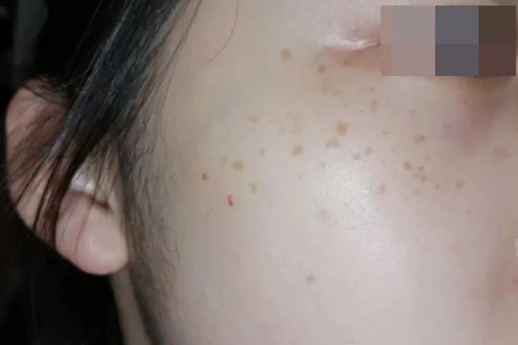 脸上斑的图片及分类图片