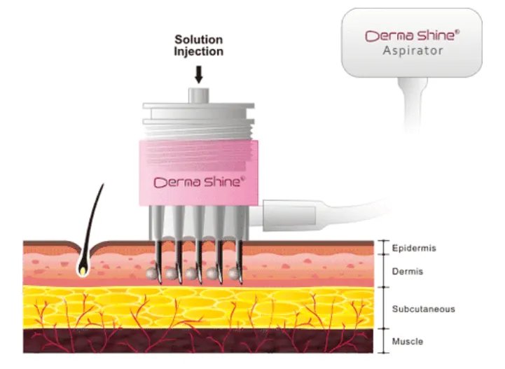 火出圈的“水光针”市场乱象不止:到底是“美容利器”还是毁容?