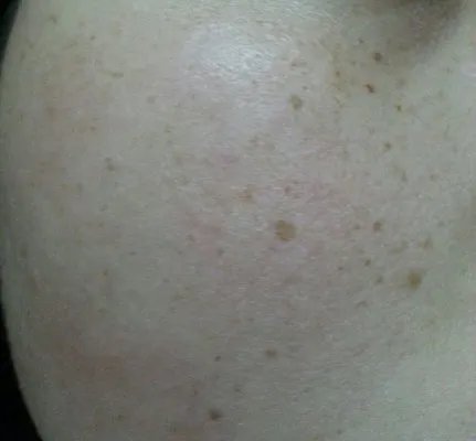 怎么消除日晒斑？