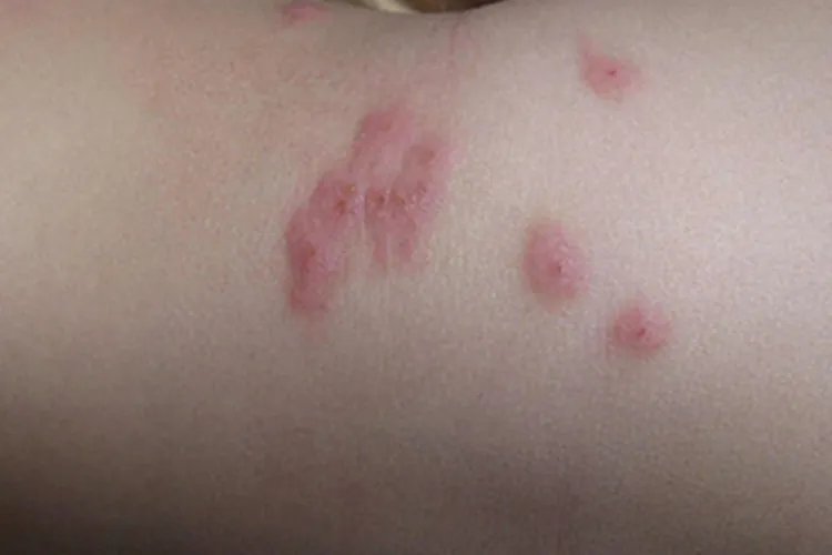 蚤病胳膊大红疙瘩图片