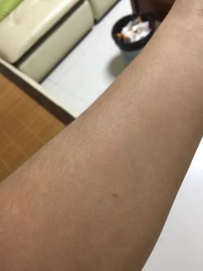 脂溢性皮炎症状？