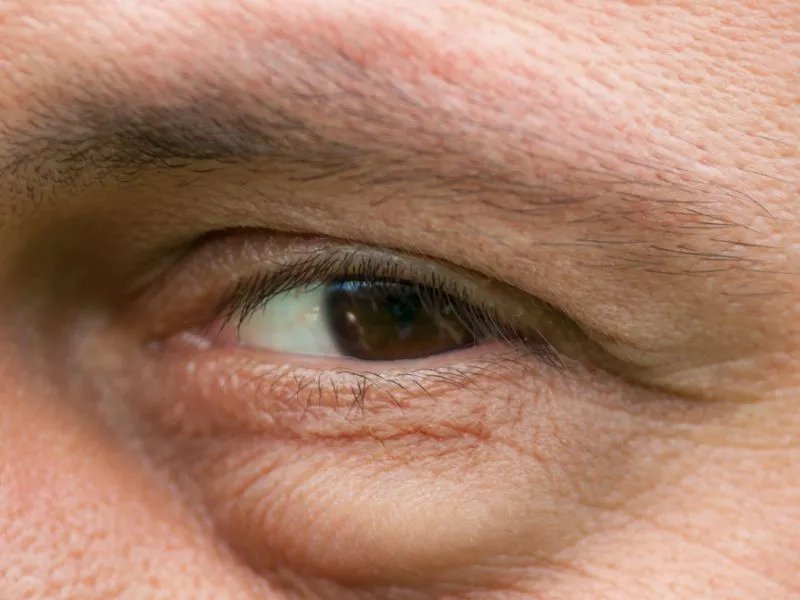 去除眼袋的方法