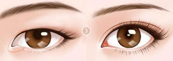 开眼角手术需要知道的一些知识