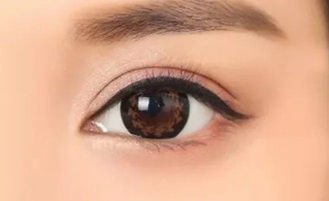 美瞳线手术有哪些后遗症？