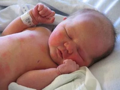 婴儿水中毒什么症状?