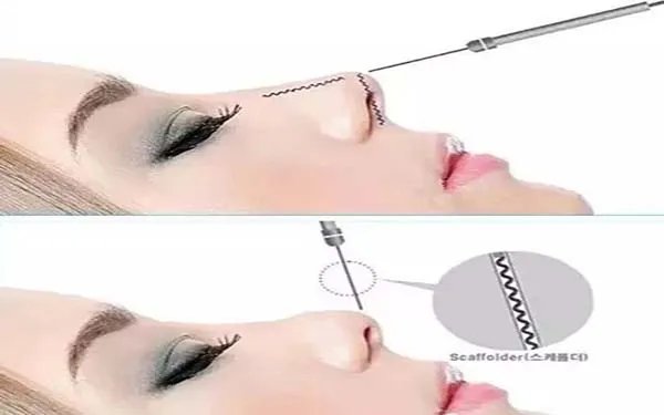 北京硅胶隆鼻哪家医院好