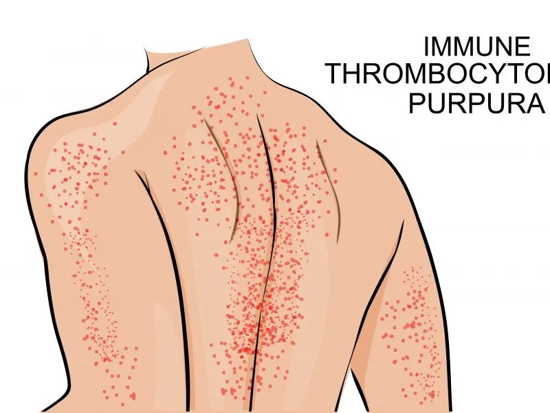 过敏性紫癜的症状